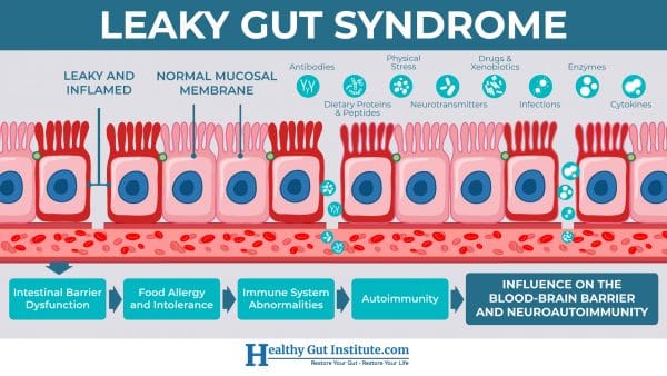 leaky gut overview