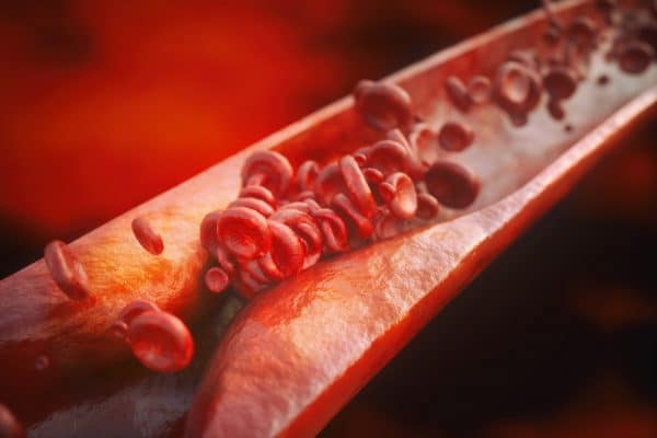 Closeup of a atherosclerosis with high details - 3D rendering