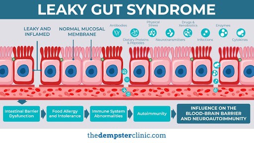 Leaky gut syndrome - what is it?
